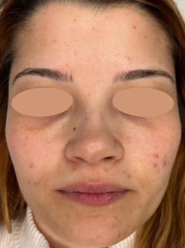 Purasomes SGC100+ pre tretmana