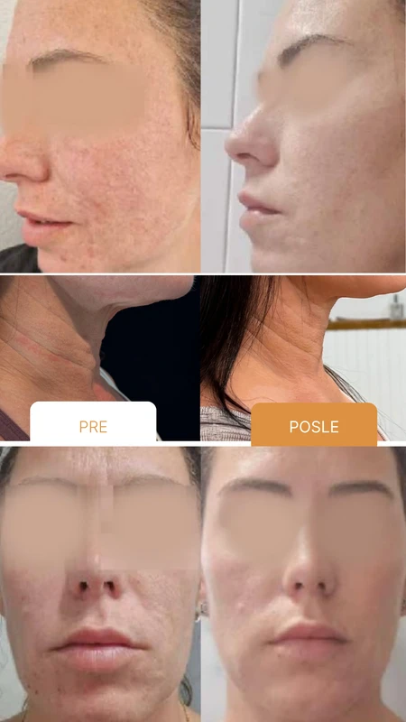 Purasomes NC150+ studija slučaja 2 &ndash; pre i posle tretmana