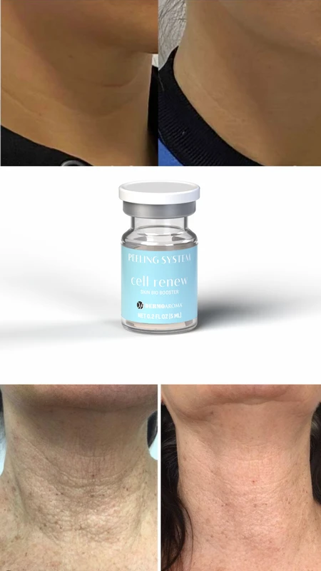 CELL RENEW Skin Bio Booster pre i posle &ndash; studija slučaja 1