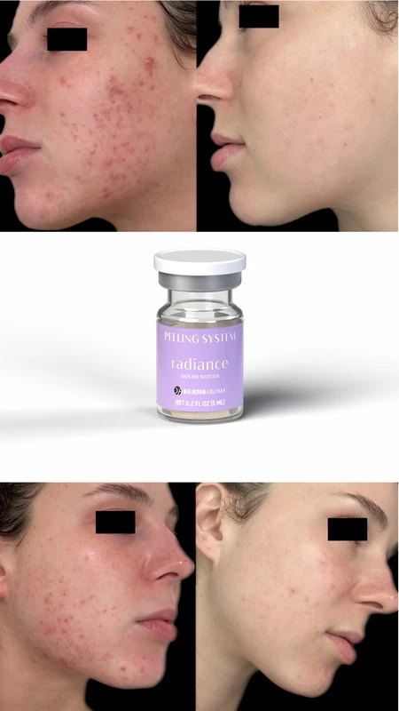 RADIANCE Skin Bio Booster pre i posle &ndash; studija slučaja 1