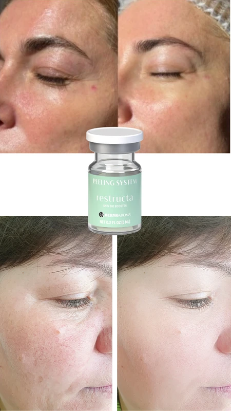RESTRUCTA Skin Bio Booster pre i posle &ndash; studija slučaja 1