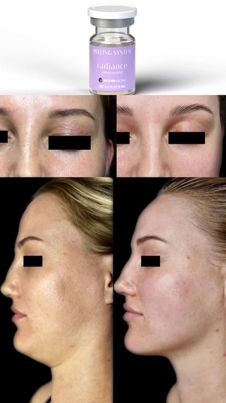 RADIANCE Skin Bio Booster pre i posle &ndash; studija slučaja 2