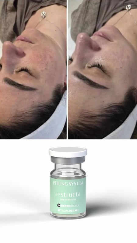 RESTRUCTA Skin Bio Booster pre i posle &ndash; studija slučaja 2