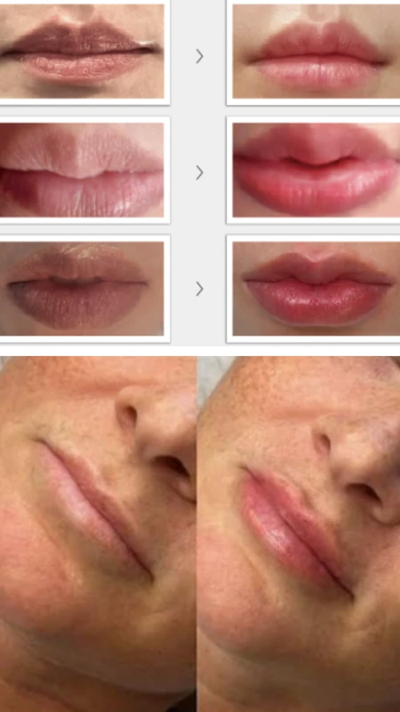 PURI LIPS pre i posle &ndash; studija slučaja 1
