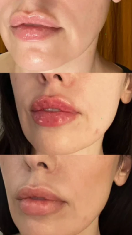 PURI LIPS pre i posle &ndash; studija slučaja 2